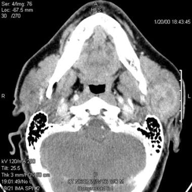 Parotid, malignant tumors. Contrast-enhanced CT im