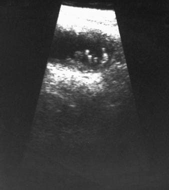 Repeat 3-month follow-up sonogram in a 53-year-old