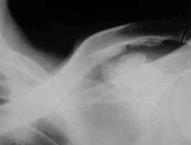 Shoulder enthesopathy. Frontal radiograph shows ir