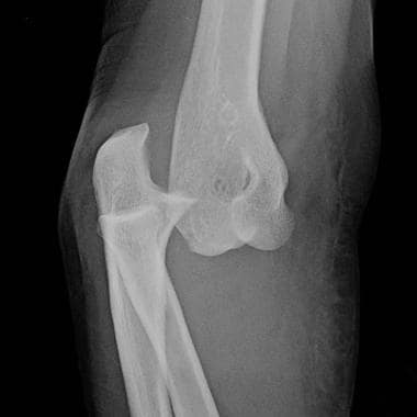 Elbow, fractures and dislocations. Posterior dislo