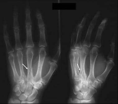 Frontal and oblique radiographs of the hand show a