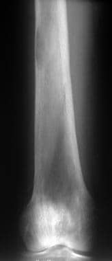 Radiograph of the distal femur in a patient with p