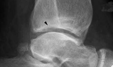 Lateral view of the ankle reveals loss of the shar