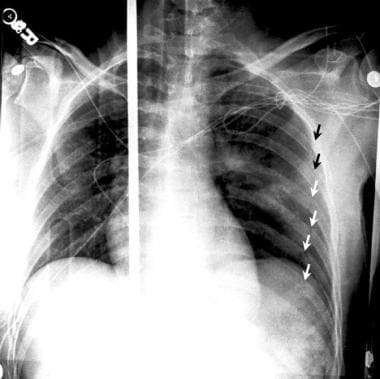 Supine anteroposterior (AP) radiografie van de borstkas die