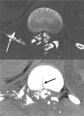 Thoracic spine trauma. Axial CT myelogram in a pat