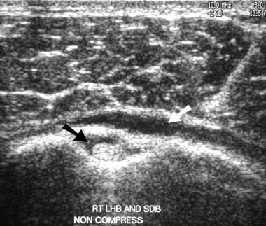 Shoulder, rotator cuff injury (ultrasonography). T
