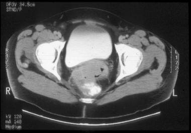 CT of parametrial and rectal invasion by cervical 
