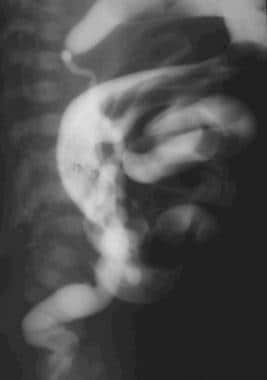 A lateral view from contrast enema in a newborn de