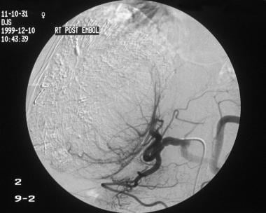 Selective hepatic angiogram obtained after chemoem