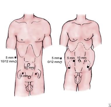 Laparoscopic Pelvic Lymph Node Dissection: Practice Essentials,  Preparation, Technique