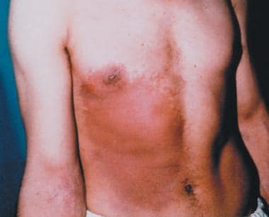 Early erythema 11 days after exposure. Image court