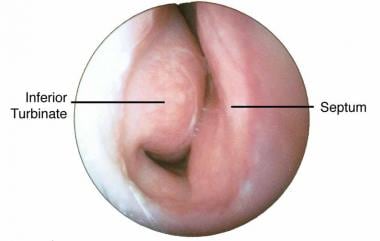 Endoscopic view from nares of right nasal passage.