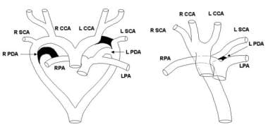 Vascular Ring and Sling Surgery. Left: Schematic d