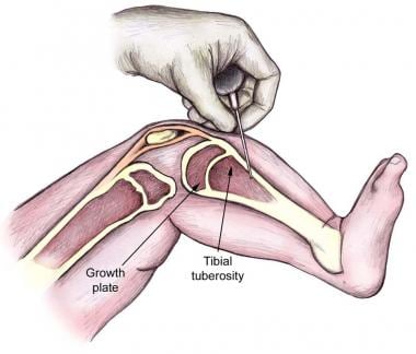 Proximal tibia intraosseous needle insertion site.