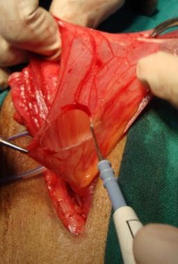 Open inguinal hernia repair. Hernia sac being divi