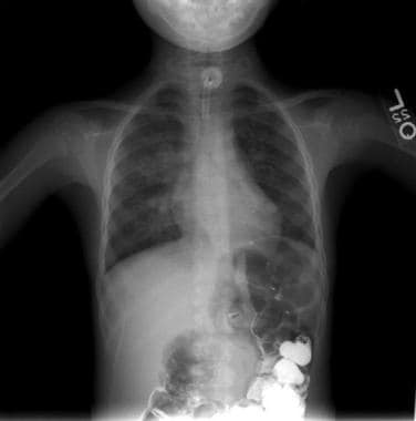 Chest radiograph of a child with a tracheostomy an
