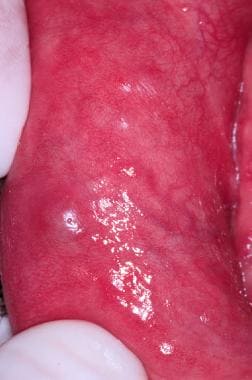 Erythema of the labial mucosa with enlargement of 