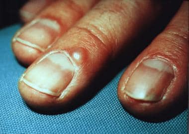 Digital mucous cyst at proximal nail fold. 