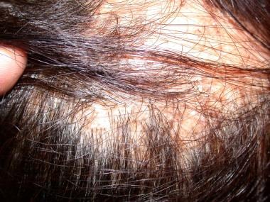 Lichen planopilaris of the scalp resulting in cica