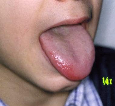 Irritant contact stomatitis of the tongue. 