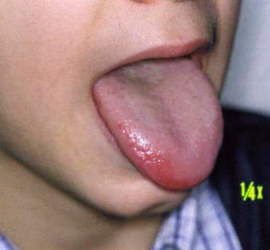 viral stomatitis adults