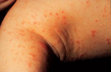 Scabies: Practice Essentials, Background, Pathophysiology