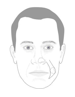 Nasal defect with planned cheek interpolation flap