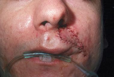 Postoperative appearance of the V-Y advancement fl