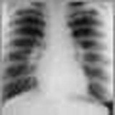 Early chest radiograph findings in sarcoidosis. 