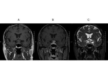 Coronal T1 precontrast MRI A (left panel), B postc
