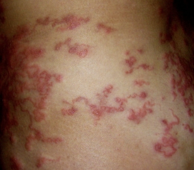 That looks hickey rash like a Slide show: