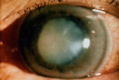 Phacomorphic glaucoma. 
