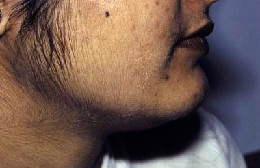 The photograph depicts familial hirsutism in a Pak