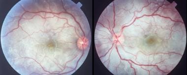 Bilateral, multifocal serous detachments in a pati