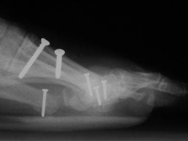Lateral radiograph of foot depicts iatrogenic hall