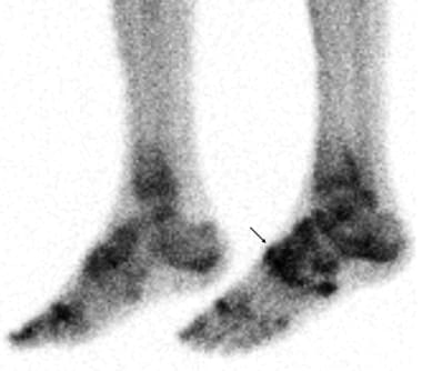 A three-phase bone scan of the feet and bone imagi