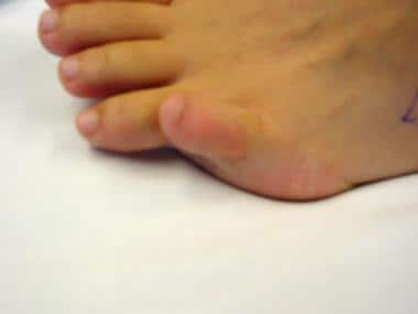 Fifth-toe deformities. This image and following im