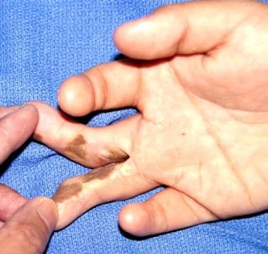 Hand of 18-year-old patient of Mediterranean herit