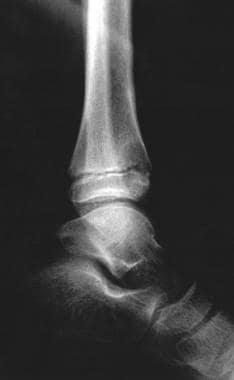 Lateral radiograph of the distal tibia. This image