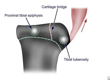 tibial tubercle palpation