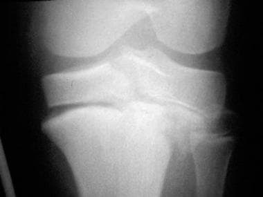 Growth plate (physeal) fractures. Displaced Salter