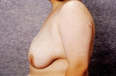 Liposuction Only Breast Reduction Treatment & Management: Medical