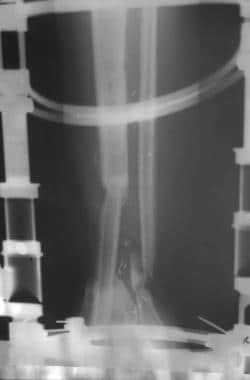 Clinical Case 2. Early postoperative radiograph of