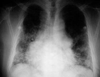 Chest radiograph of a 50-year-old man with immunog