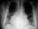 Immunoglobulin A Deficiency