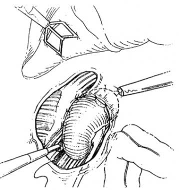 Transperitoneal laparoscopic nephropexy. The later