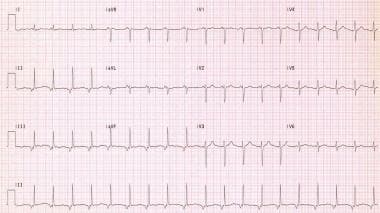 junctional escape rhythm life in teh fast lane