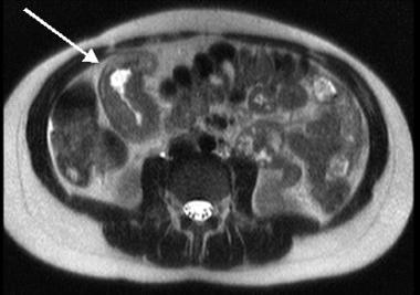 Crohn disease. This magnetic resonance image demon