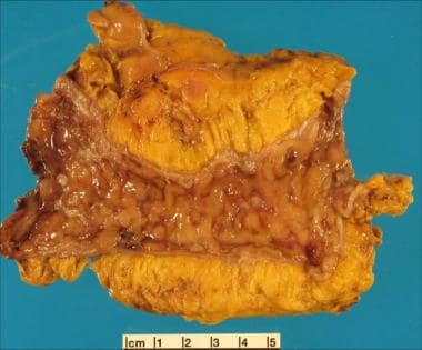 Inflammatory bowel disease. Cobblestone change of 