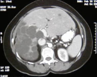 Computed tomography (CT) scan of polycystic liver 
